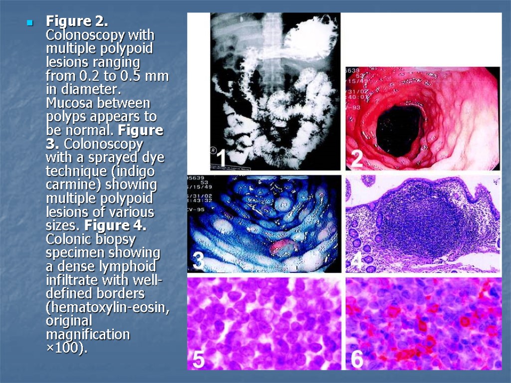 Figure 2. Colonoscopy with multiple polypoid lesions ranging from 0.2 to 0.5 mm in